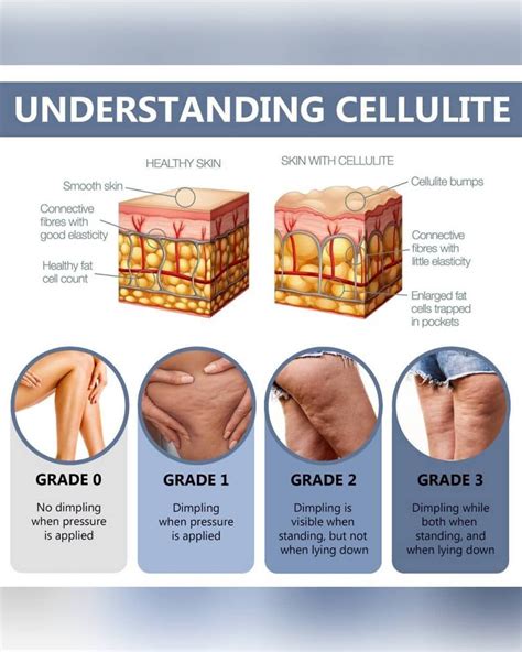 Cellulite,